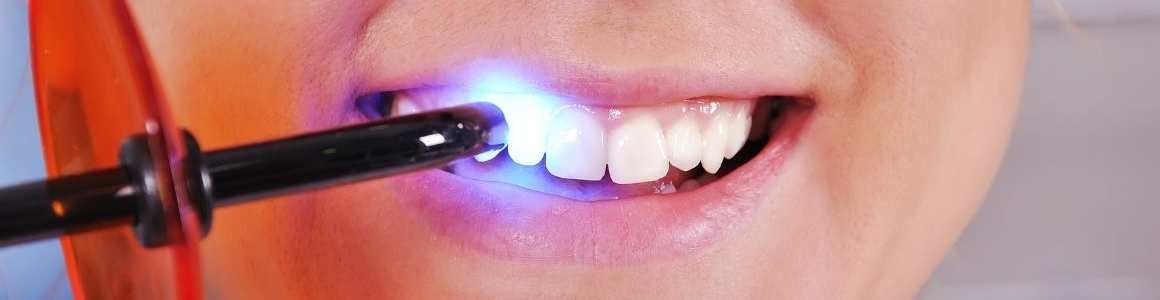 Tooth-Colored Fillings and What They Are About